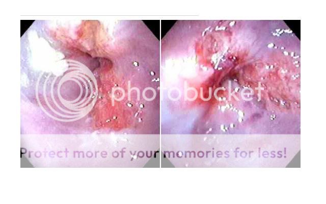 SCC oesophagus Pictures, Images and Photos
